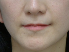 WPRPF nasolabial after-thumb-500x375-1281.jpgのサムネール画像